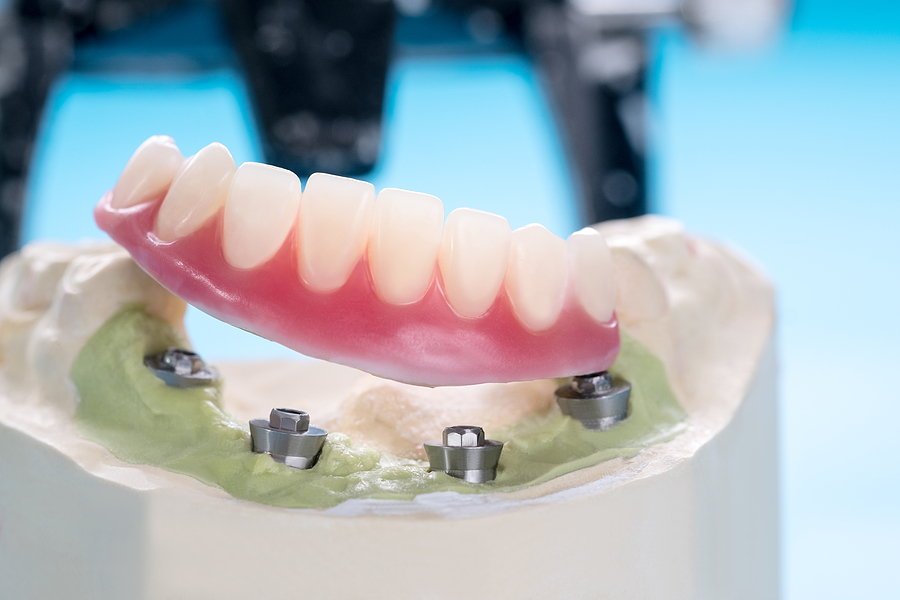 Are Dental Implants in San Diego, CA, Safe in the Long Run?