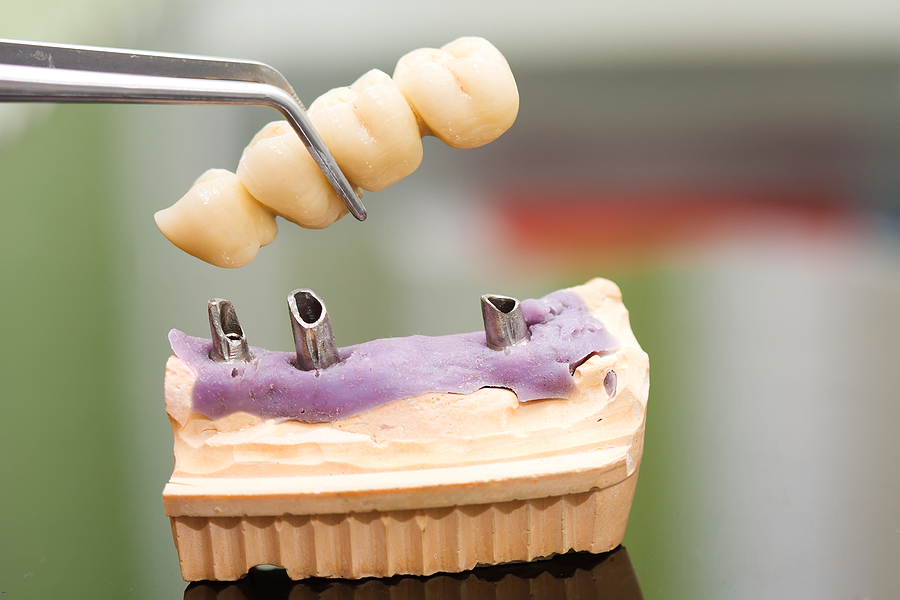 Is the Dental Implant Procedure in San Diego, CA, Painful?