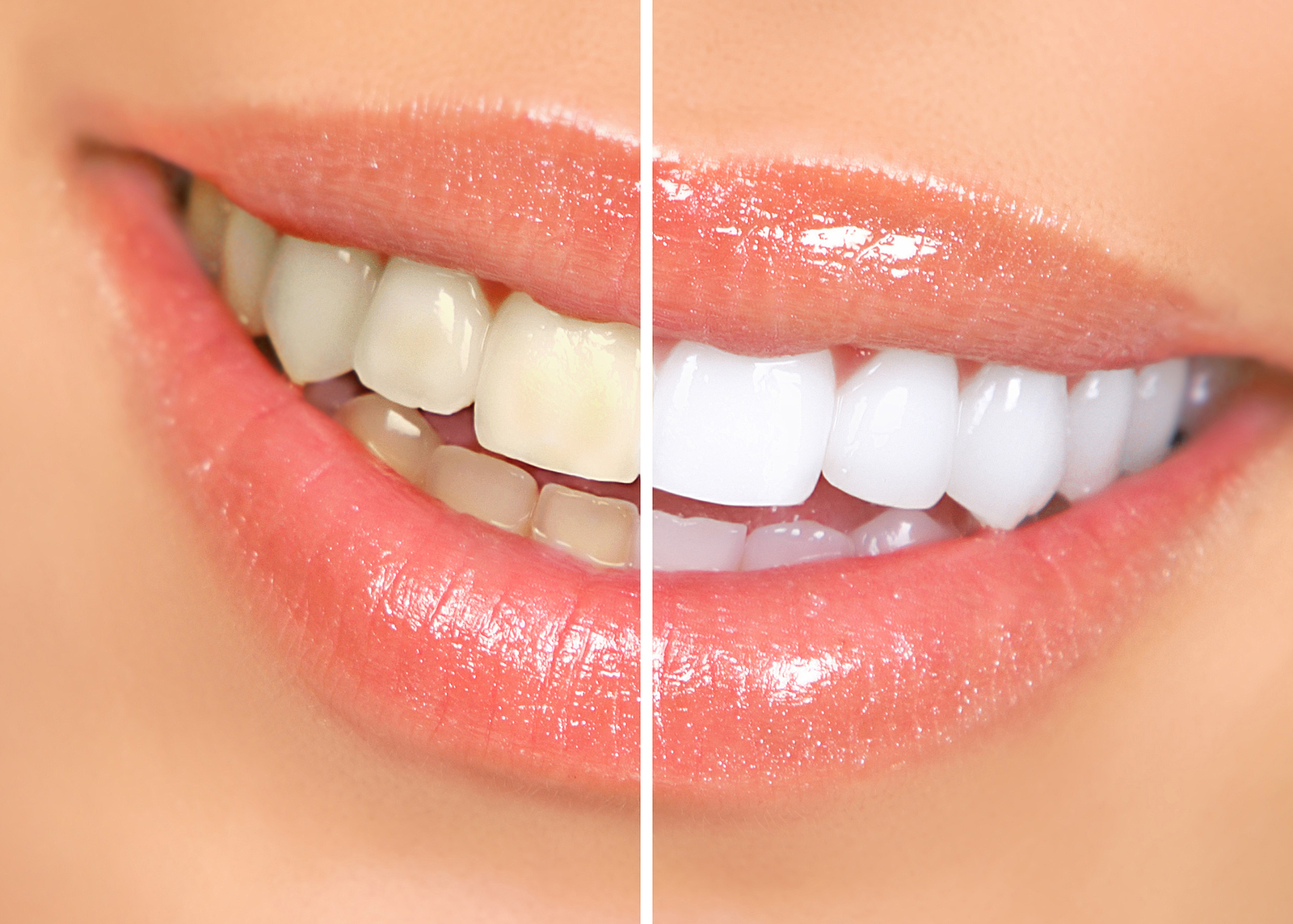 How To Get Whiter Teeth