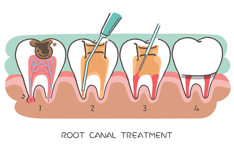 Everything You Need to Know About Root Canal Therapy in San Diego, CA