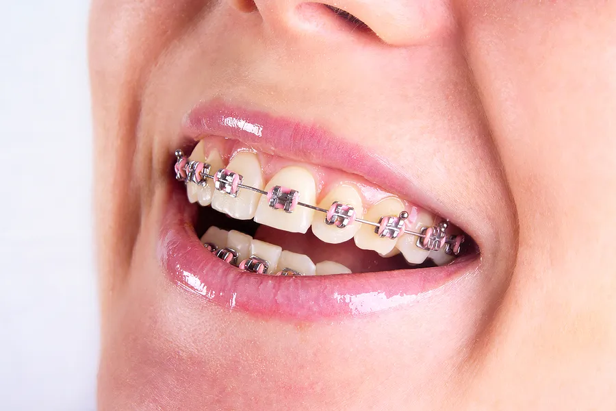 The Usual Requirements in Getting Dental Braces