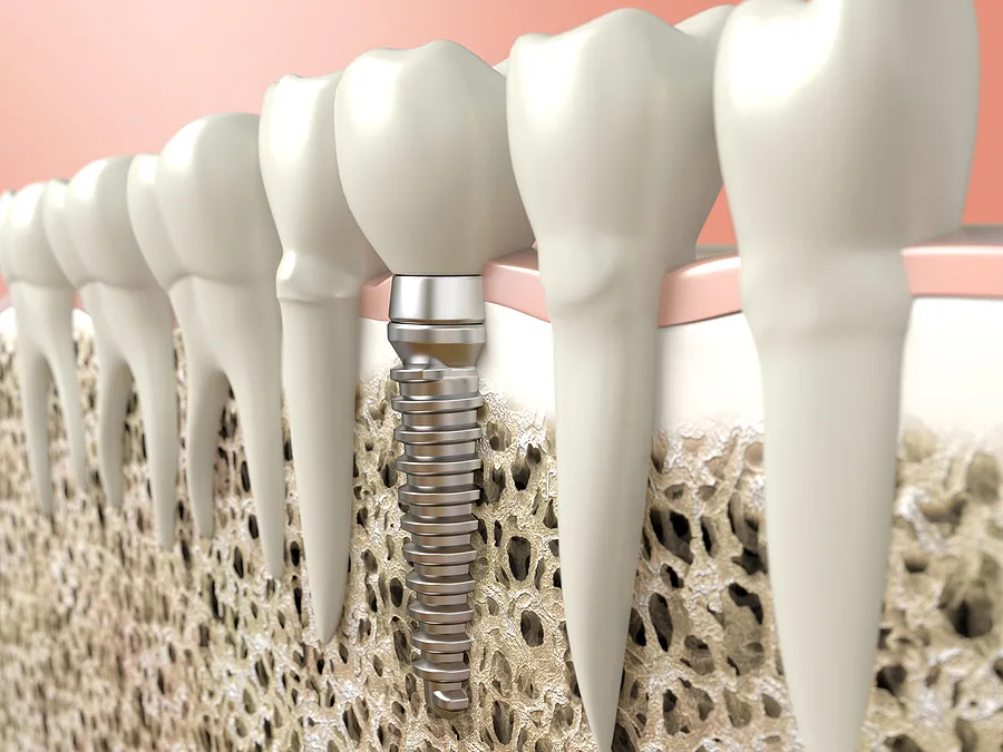 Dental Implants: Restoring Smiles with Advanced Tooth Replacement Solutions