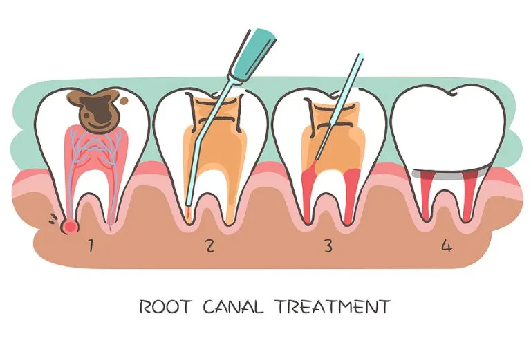 Everything You Need to Know About Root Canal Therapy